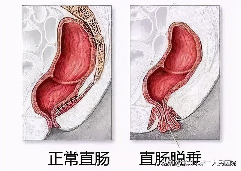 脱肛直肠坏死的早期症状,直肠脱垂有肉球脱出吗