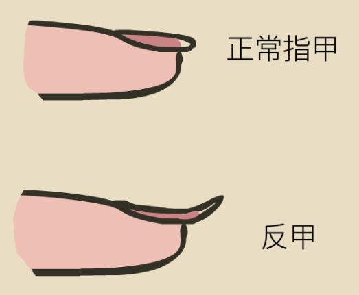 指甲上有凹痕是什么原因,指甲出现甲凹点是什么原因