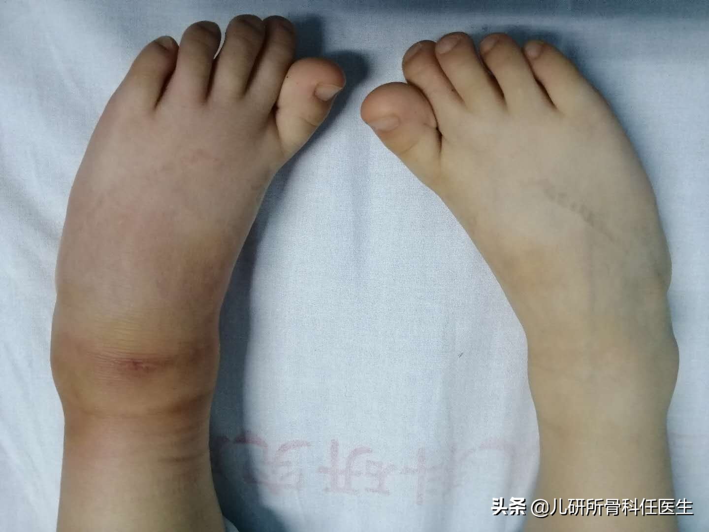 宝宝被蚊虫叮咬了怎么办,宝宝被蚊虫叮咬了用什么药