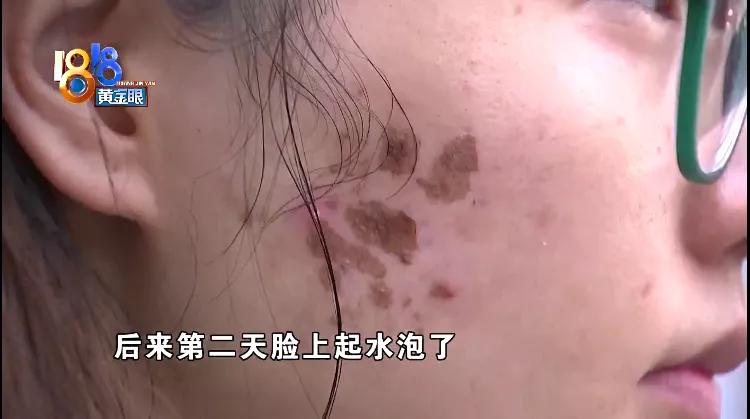 光子嫩肤后满脸黑点,光子嫩肤结痂想化妆怎么办