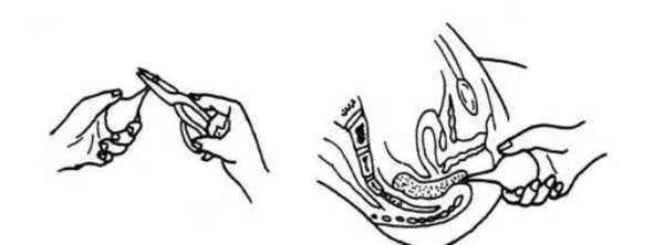 到底如何使用开塞露呢？