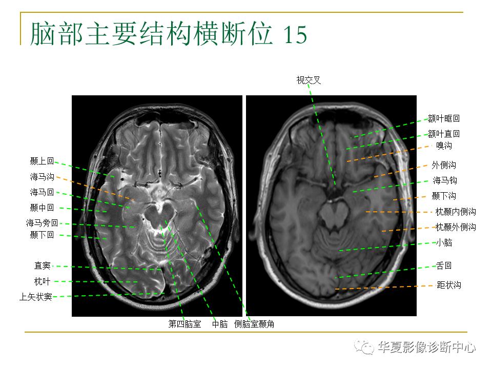中国人脑立体定向mri应用解剖图谱,脑mri示意图