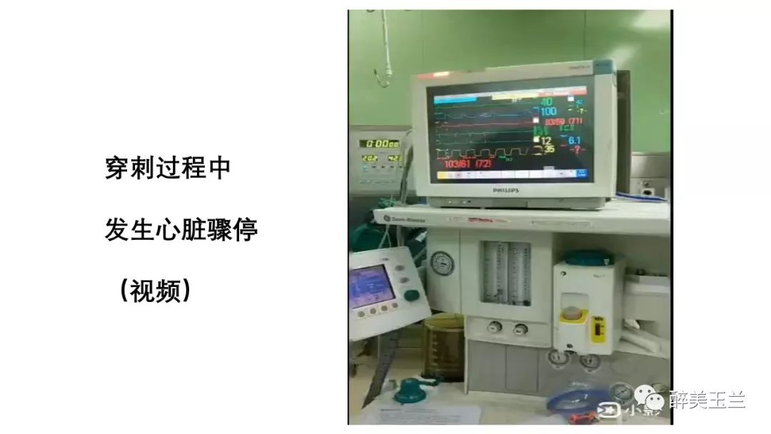 病例分享丨三叉神经节微球囊压迫术的麻醉管理