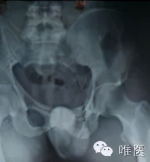 腰椎压缩性骨折保守治疗畸形愈合,骨折或关节脱位的急救处理