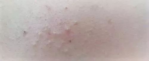 哪种果酸治闭口最好用,什么果酸对闭口有用