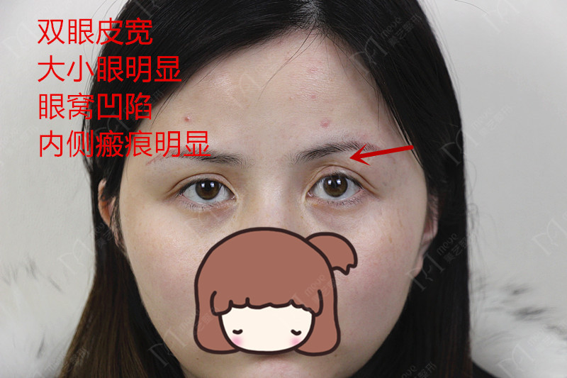 双眼皮失败了怎么修复好,双眼皮修复失败怎么解决