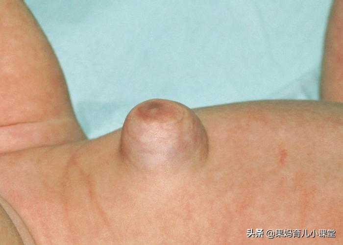 宝宝脐疝怎么处理好得快,宝宝脐疝要怎么处理