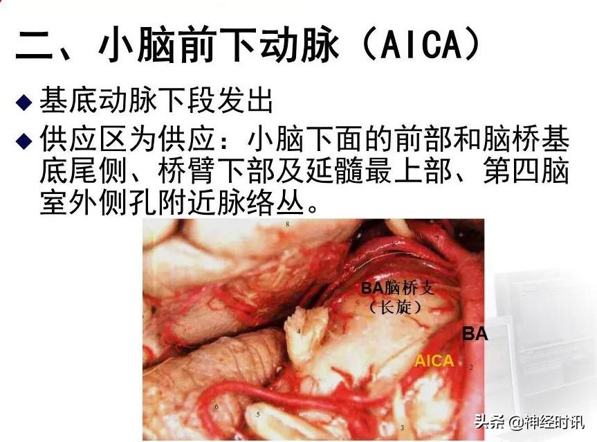 脑动脉解剖学讲解,脑膜中动脉解剖讲解