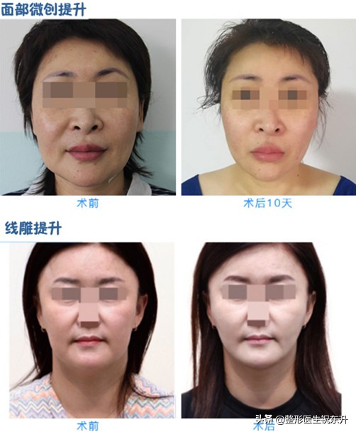 怎样可以去除法令纹和皱纹,如何消除法令纹提升脸部轮廓