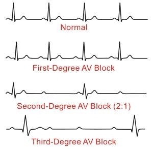 儿童感冒了心肌酶高能自愈吗,六岁孩子心肌酶偏高大夫说心肌炎