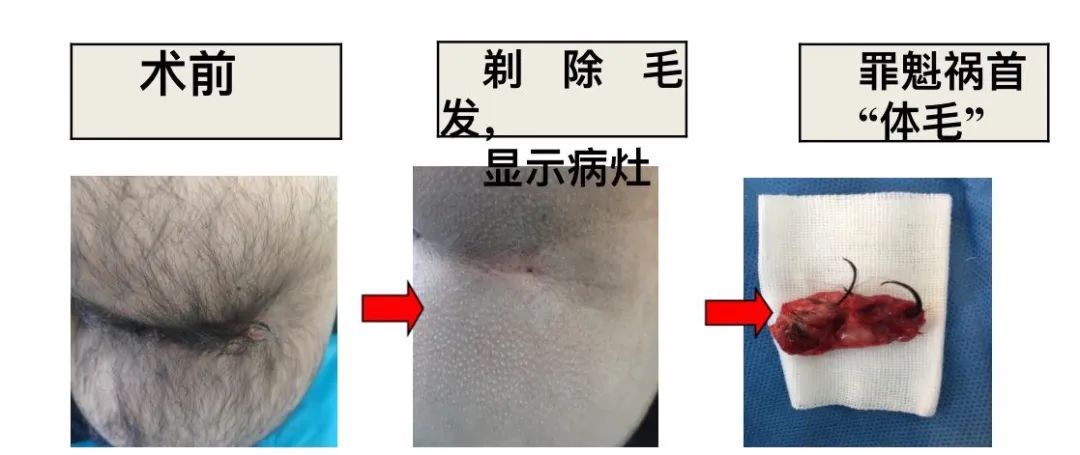 骶尾藏毛窦多毛的罪魁祸首,尾部藏毛窦治疗方法