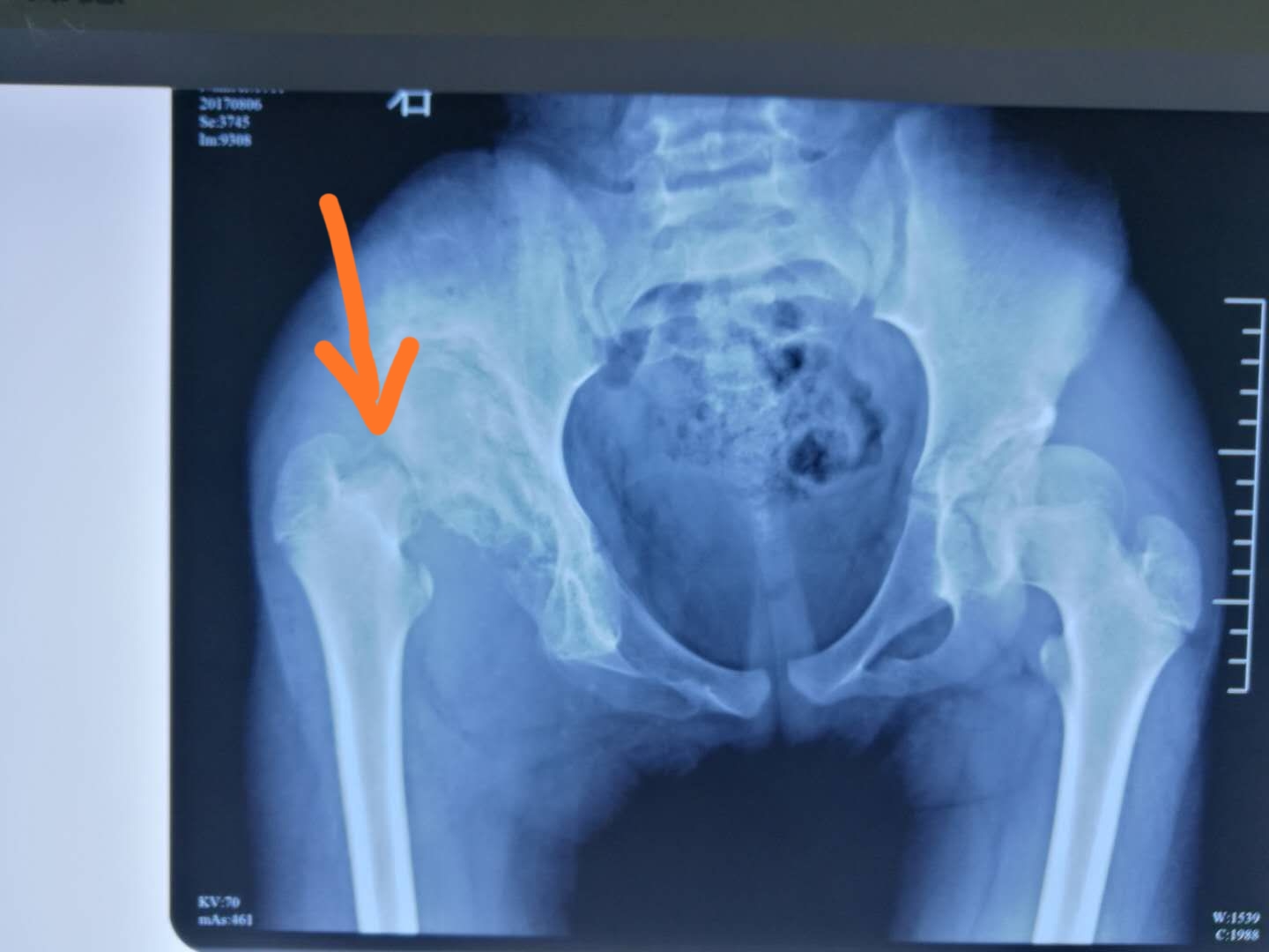 花季少女失去知觉,15岁花季少女得了一种罕见的病