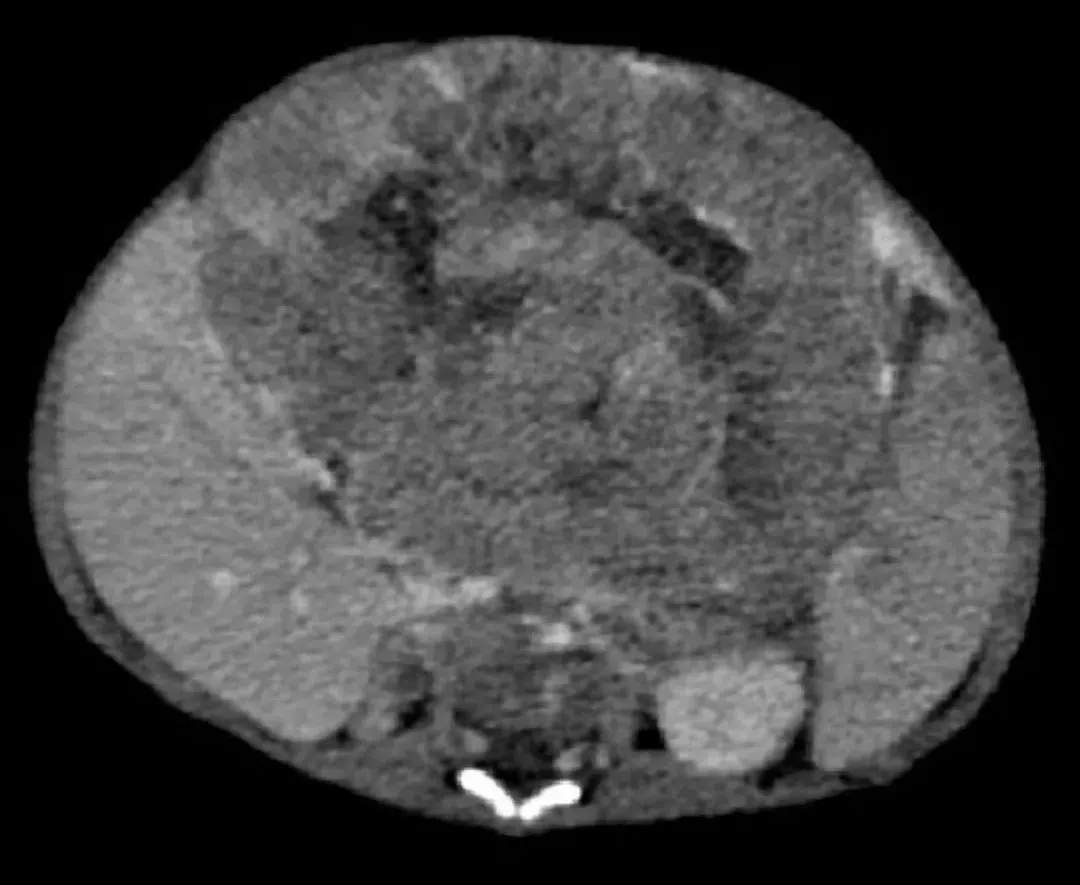 肝母细胞瘤手术婴儿多大能做,4个月婴儿长17厘米肿瘤