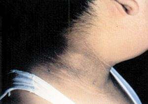 颈部黑棘皮症是什么引起的,糖尿病黑棘皮症用什么治疗