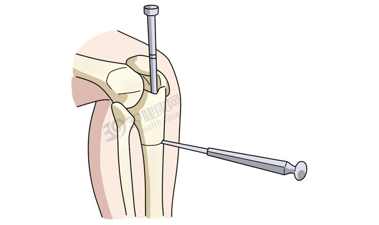 做断骨增高的人怎么样了,做了断骨增高看得出来吗