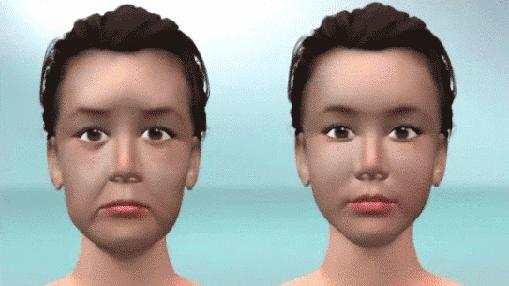 线雕术后的注意事项,线雕鼻术后注意事项