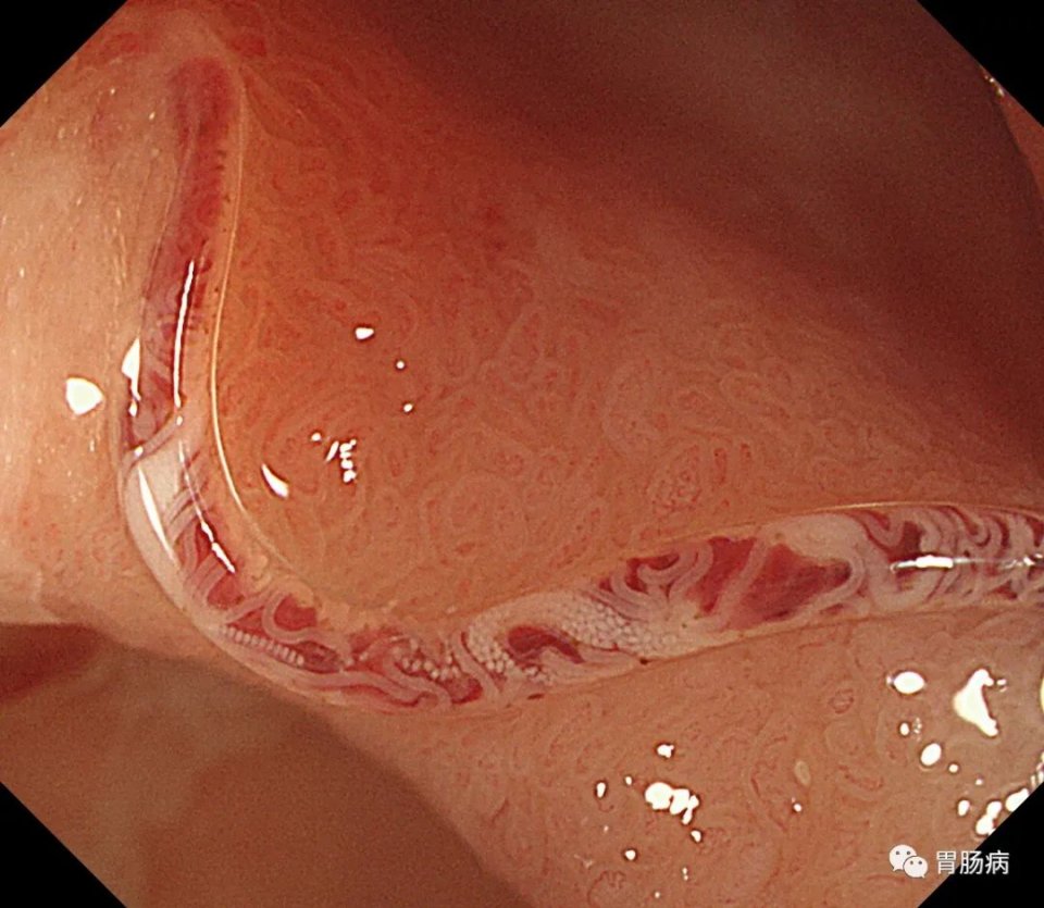 腹痛查不出病因全部检查都做了,腹痛查不出病因视频