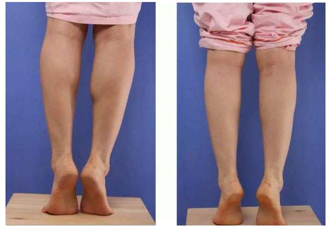 肌肉腿很苦恼？别努力错了，详细解说肌肉腿脂肪腿区别和解决