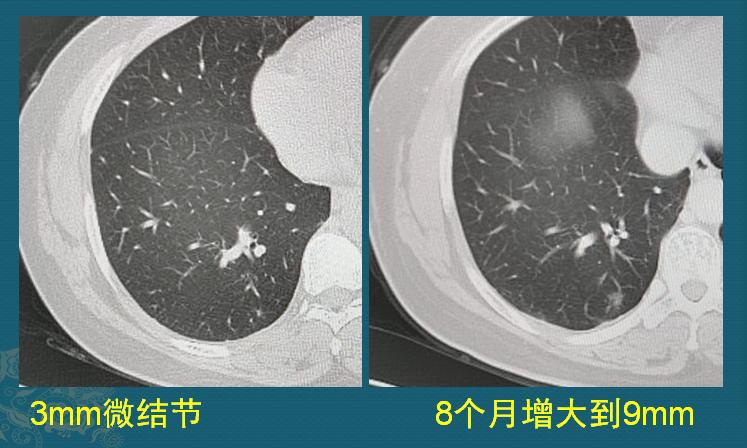 查出磨玻璃肺结节心里慌，该怎么做才保险？参考一下这6个