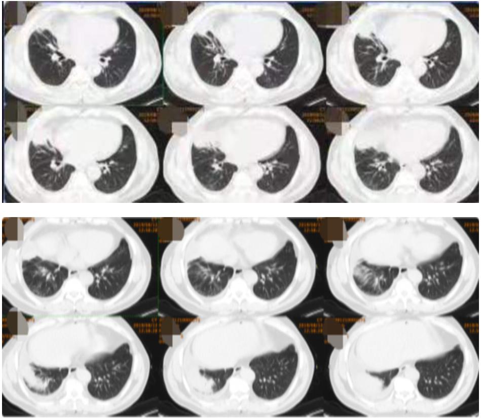 56岁男性发现双肺数百个结节,肺部肿块伴胸腔积液