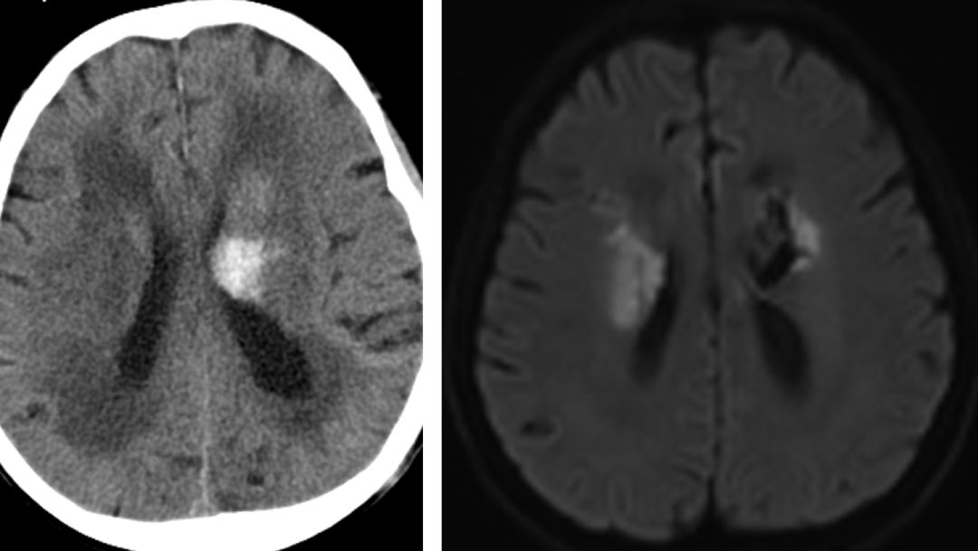 脑梗溶栓后脑出血脑疝晚期,阿替普酶溶栓后脑出血处理