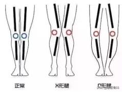 跳高之星身高体重,跳高冠军长高秘籍