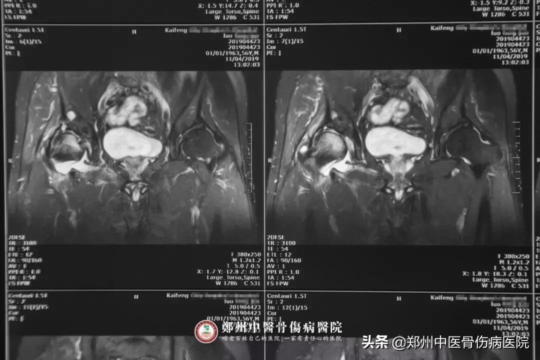 股骨头坏死换全髋康复后注意哪些,股骨头坏死手术置换多久可以康复