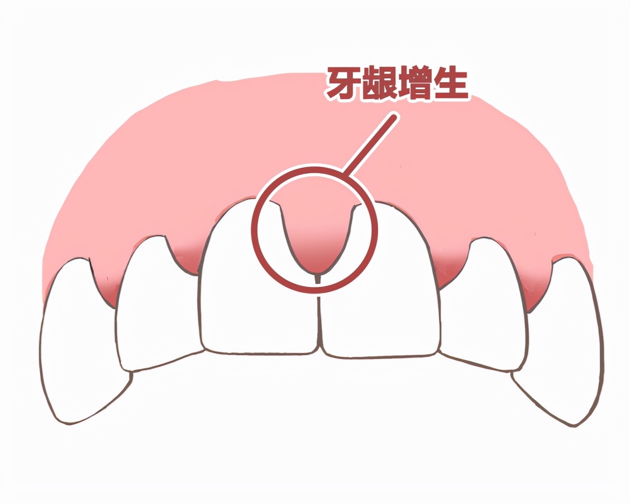 肾移植牙龈增生怎么办,肾移植后牙龈增生可以用药吗