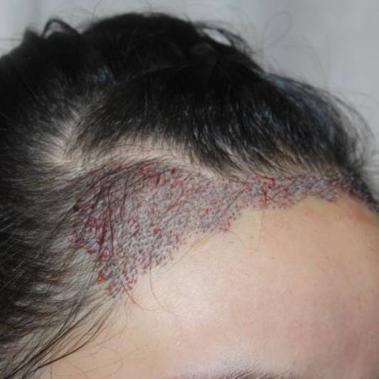 植发后取发区多久恢复正常,三级脱发植发能恢复到原来吗