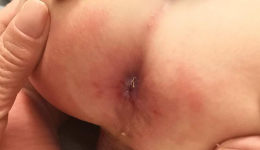 宝宝大便化验有脓细胞吃什么药,宝宝大便里有血丝粘液细菌性感染