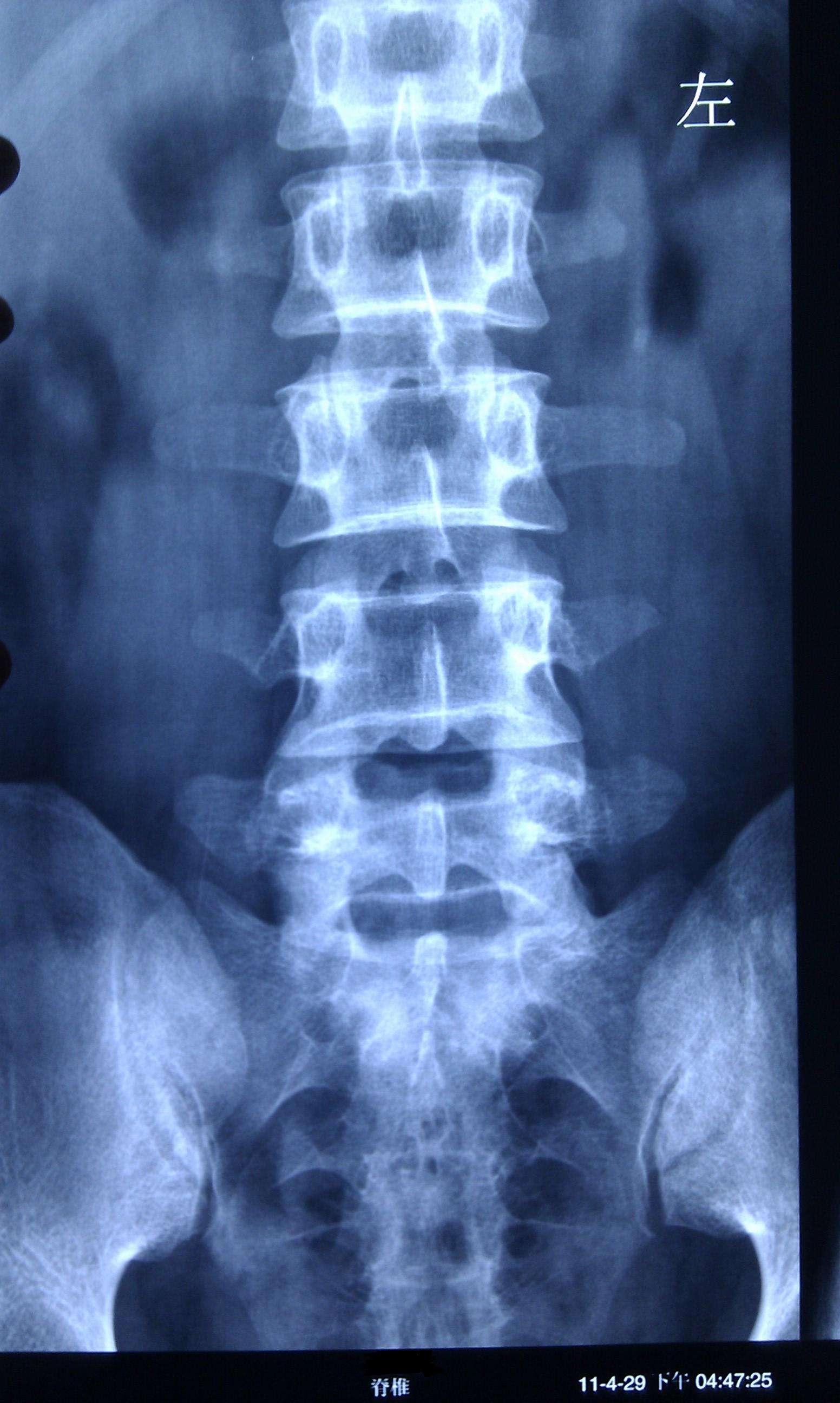 腰三横突综合征疼痛缓解方法,第三腰突综合症腰疼怎么治疗