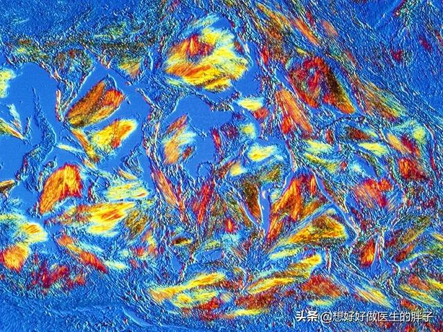 辟谣尿酸高就一定会引发痛风,辟谣痛风