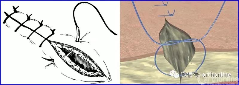 常用的手术缝合方法图,临床常见常用伤口缝合方法