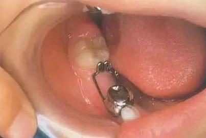 小孩乳牙不小心咽下去了怎么办,儿童乳牙摔松动了能自己恢复吗