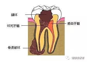 牙齿掉了一半是补牙还是植牙,牙齿烂了为什么不能拔