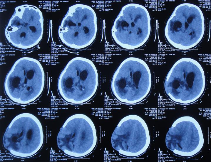 脑室有粘连脑积水有什么办法,脑动脉畸形手术后出现急性脑积水