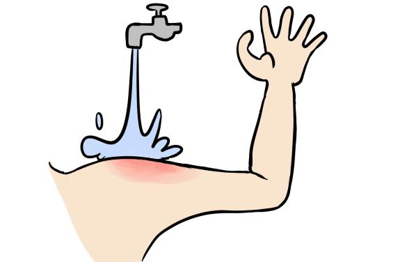 开水烫伤怎么判定严不严重,小孩被开水烫伤较严重该怎么办