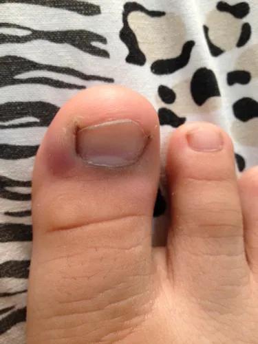 儿童怎么预防甲沟炎,美甲能预防甲沟炎吗