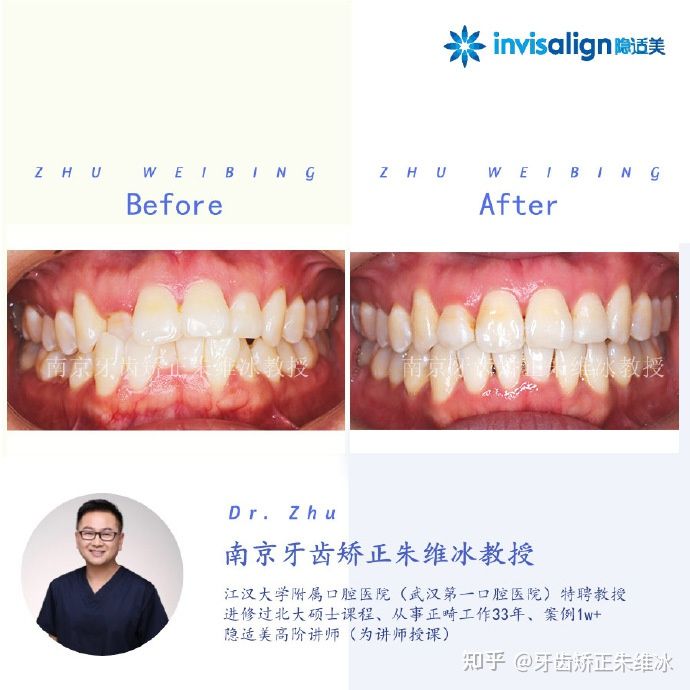 牙齿歪矫正,南京成人牙齿矫正牙齿不齐