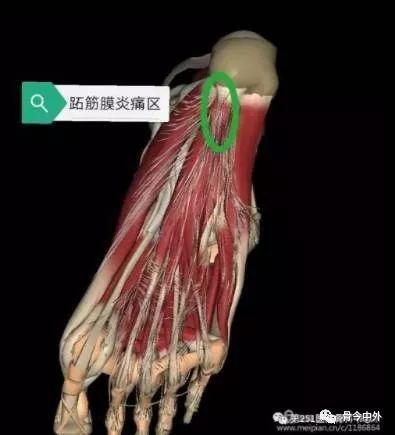 足跟痛应该怎么治疗最好,足跟痛怎么治呢