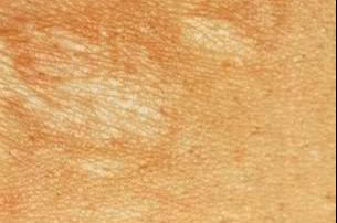 为什么受伤后会留疤？留疤后该怎样处理？