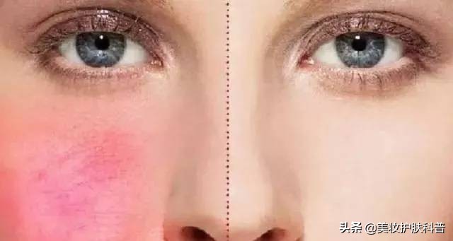 皮肤有血丝有点红怎么修复,红血丝养肤