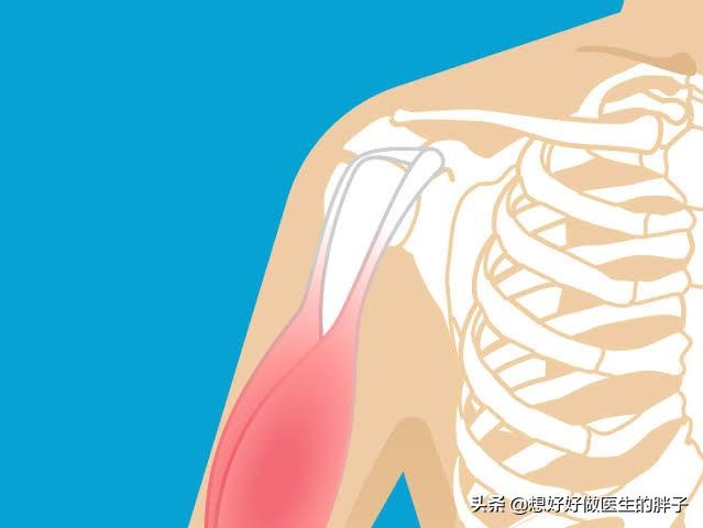 什么是肌腱损伤,怎么判断是韧带损伤还是肌腱炎