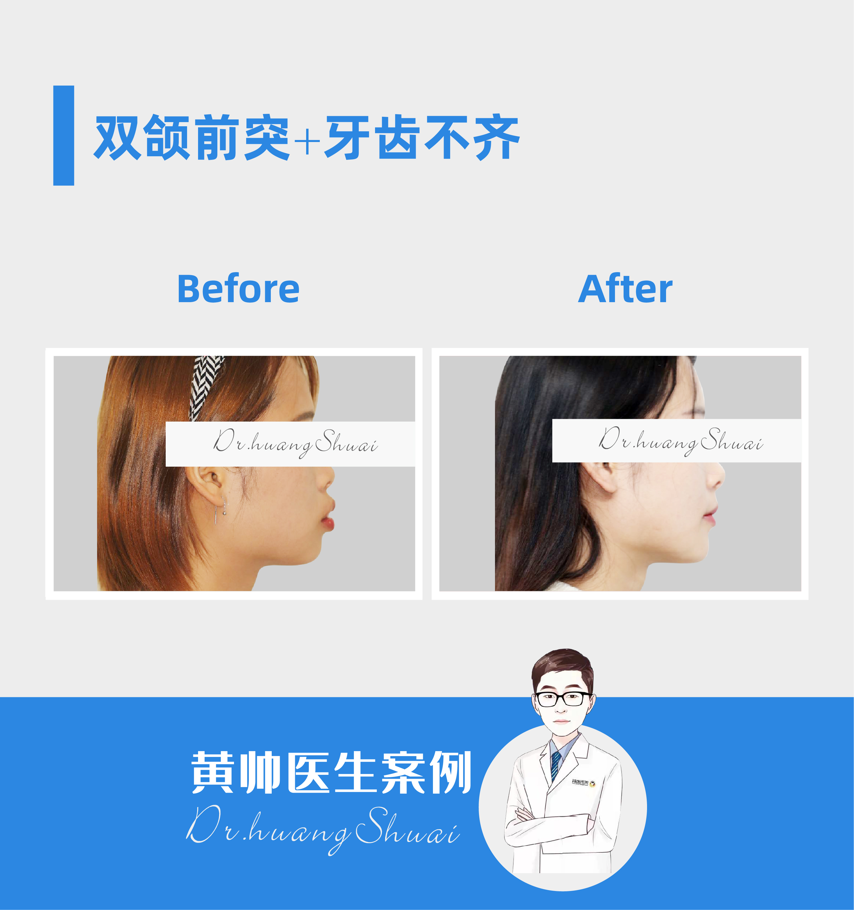 嘴凸牙齿矫正前后对比视频,牙齿矫正拔智齿可以怎样改善嘴凸