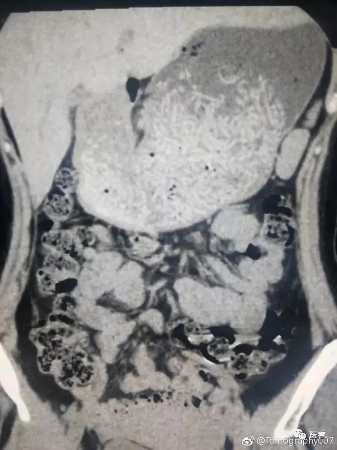 这就是空腹拍片的原因！听医生的话别让他受伤......