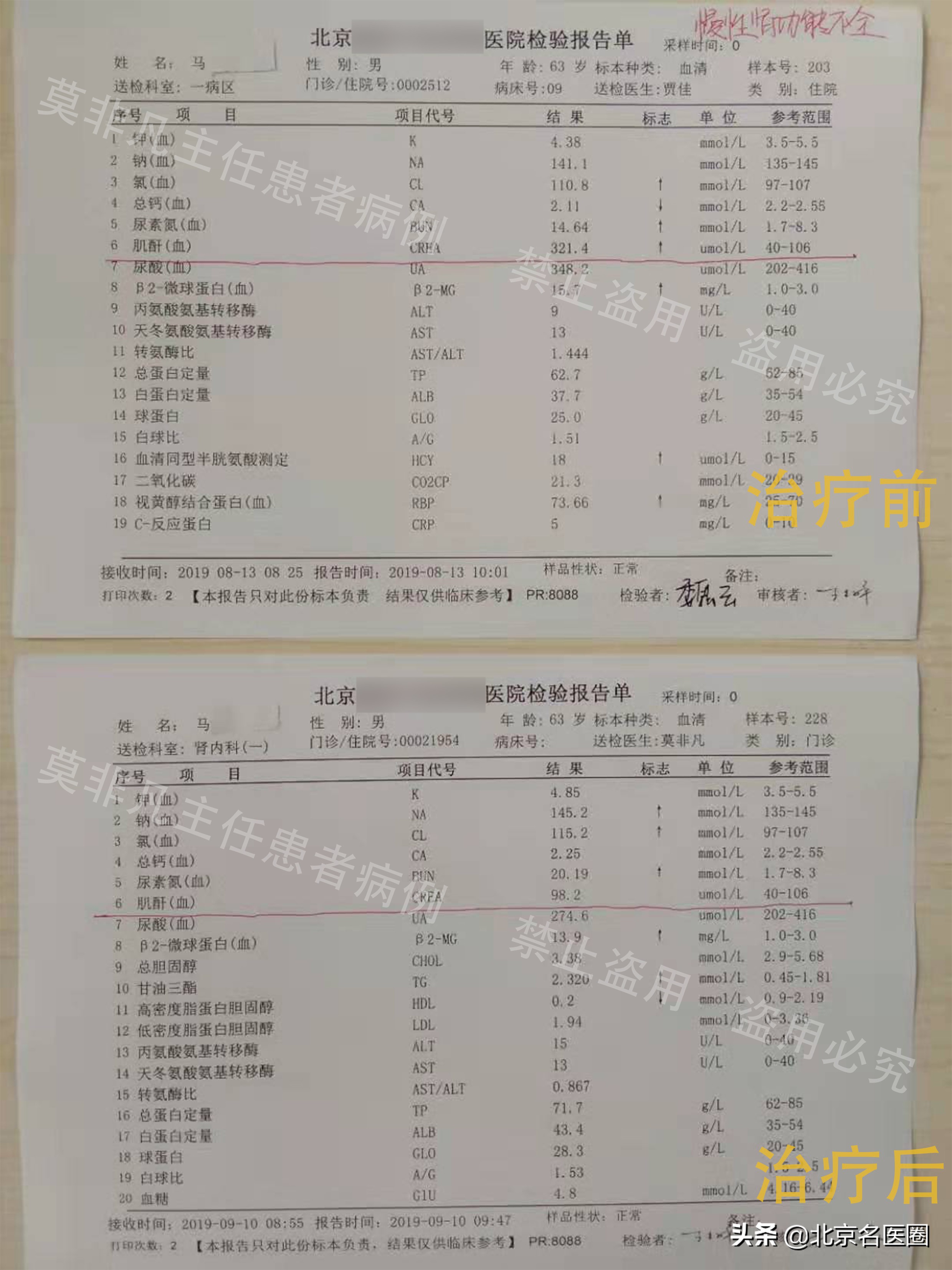 肾功能不全一周三次透析直到死亡,62岁慢性肾功能不全乏力