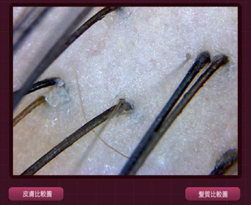 毛囊检测告诉你毛囊萎缩,头皮检测和毛囊检测有区别吗