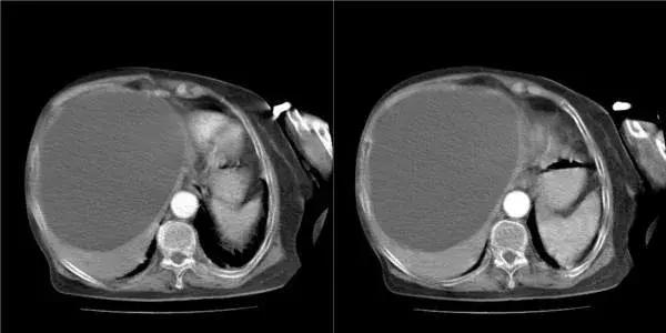发现肝部有小结节用治疗吗,发现肝脏结节要做哪些检查