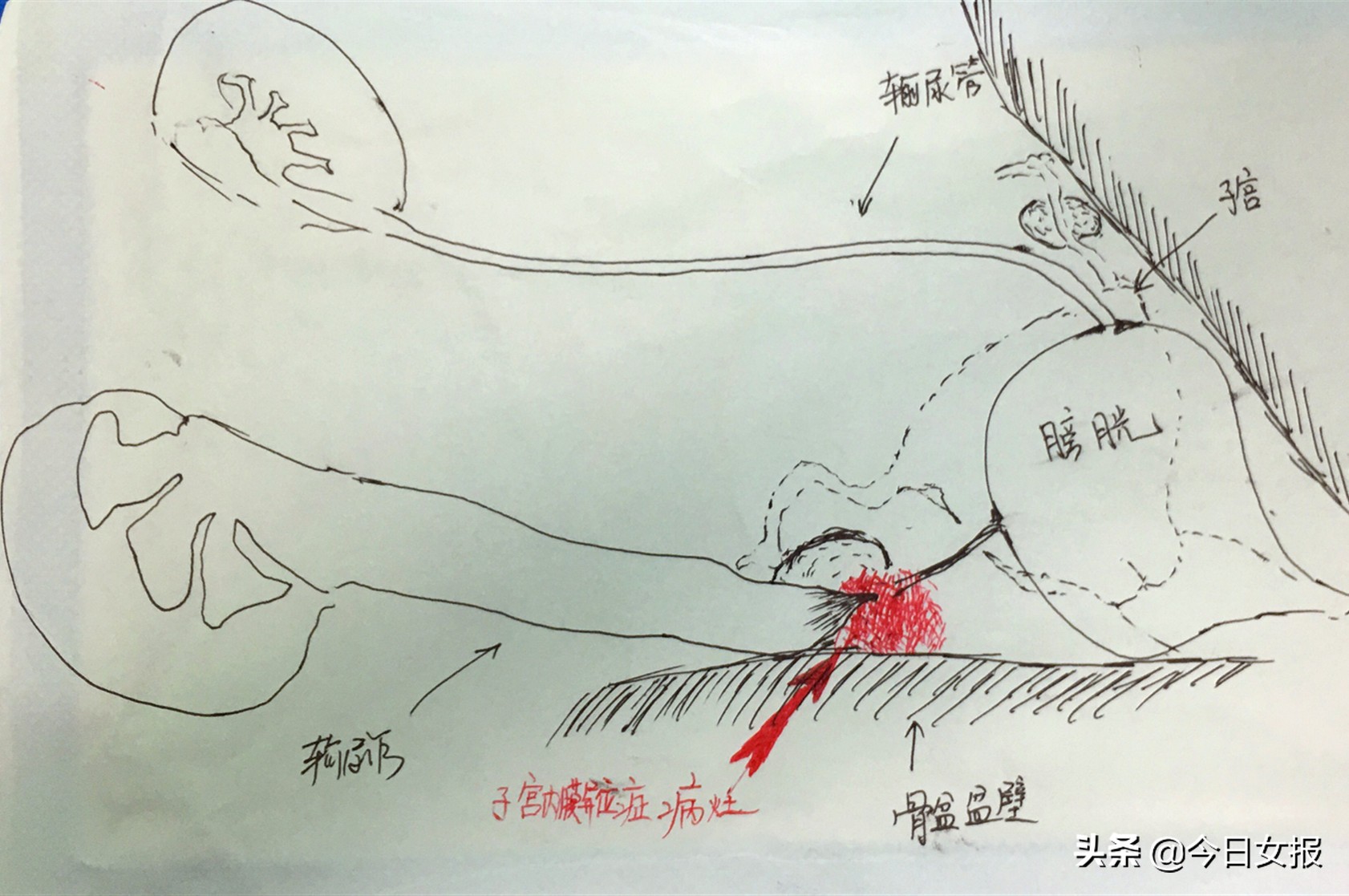 长沙40岁女子腰疼半年重度肾积水，月经反复来访！罪魁祸首竟是这发病率高达10%的妇科病