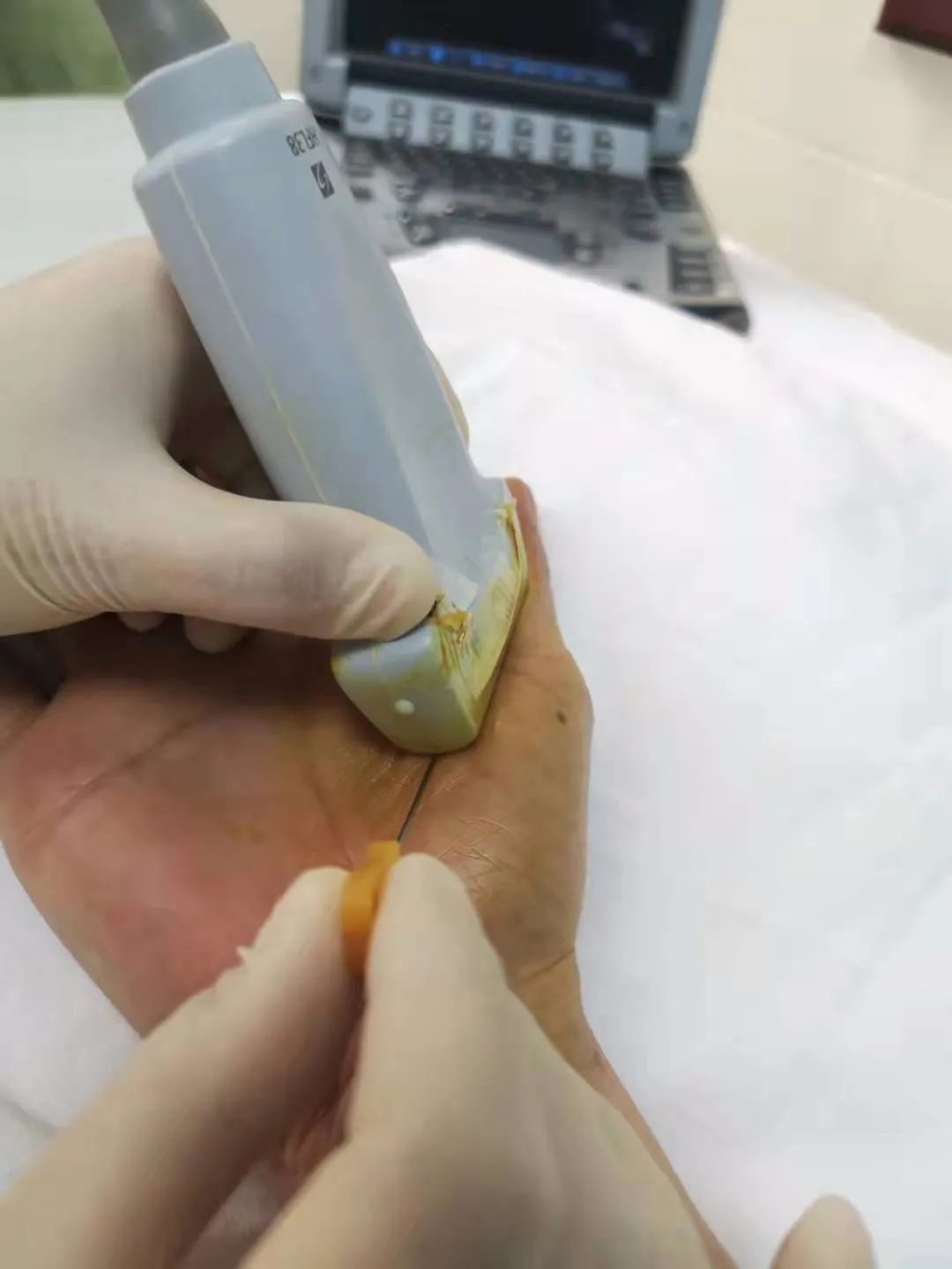 弹响指按摩哪个穴位能治,可视化小针刀松解视频